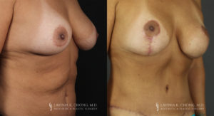 Mommy Makeover Patient 6395 Before & After B