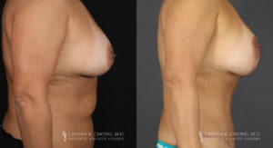 Mommy Makeover Patient 6395 Before & After C