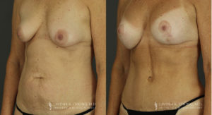 Mommy Makeover Patient 6597 Before & After A