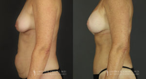 Mommy Makeover Patient 6597 Before & After B