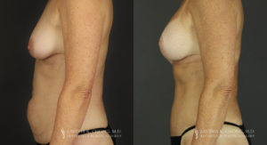 Mommy Makeover Patient 6597 Before & After B