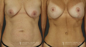Mommy Makeover Patient 6597 Before & After C
