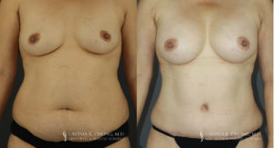 Mommy Makeover Patient 7010 Before & After C