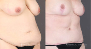 Mommy Makeover Patient 8294 Before & After A