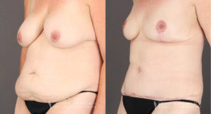 Mommy Makeover Patient 8294 Before & After B