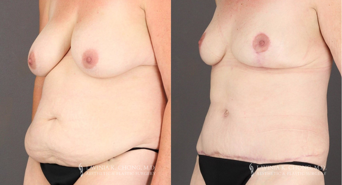 Mommy Makeover Patient 8294 Before & After B