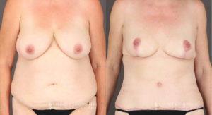 Mommy Makeover Patient 8294 Before & After C