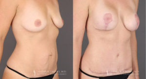 Mommy Makeover Patient 8355 Before & After A