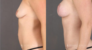 Mommy Makeover Patient 8355 Before & After B