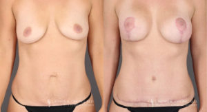 Mommy Makeover Patient 8355 Before & After C