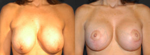 Implant Exchange Before & After Photo Patient 1 - Front View