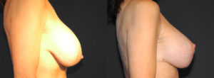 Implant Exchange Before & After Photo Patient 1 - Side View