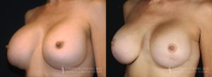 Implant Exchange Before & After Photo Patient 4 - Angled View