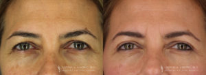 Eyelid Patient 7379 B&A C