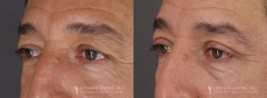 Eyelid Patient 8255 B&A A