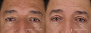 Eyelid Patient 8255 B&A B