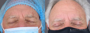 Eyelid Patient 8490 B&A A