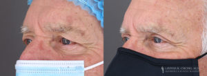 Eyelid Patient 8490 B&A C