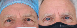 Eyelid Patient 8490 B&A D