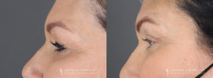 Eyelid Patient 8496 B&A A