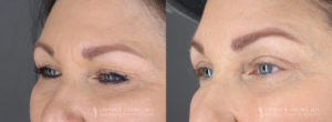 Eyelid Patient 8496 B&A B