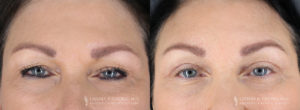 Eyelid Patient 8496 B&A C