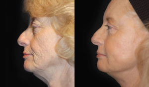 Patient 3.1 Before & After Facelift