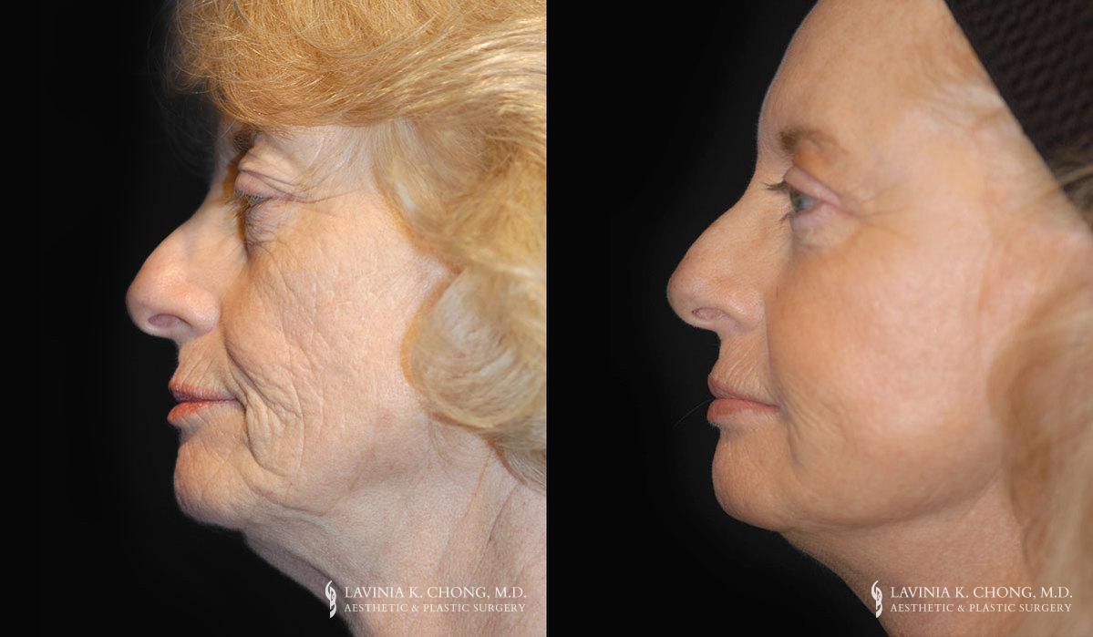 Patient 3.1 Before & After Facelift