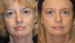Patient 3.3 Before & After Facelift