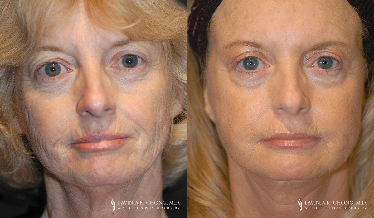 Patient 3.3 Before & After Facelift