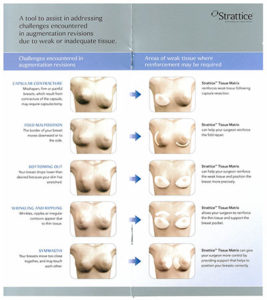 Breast Diagram of Strattice