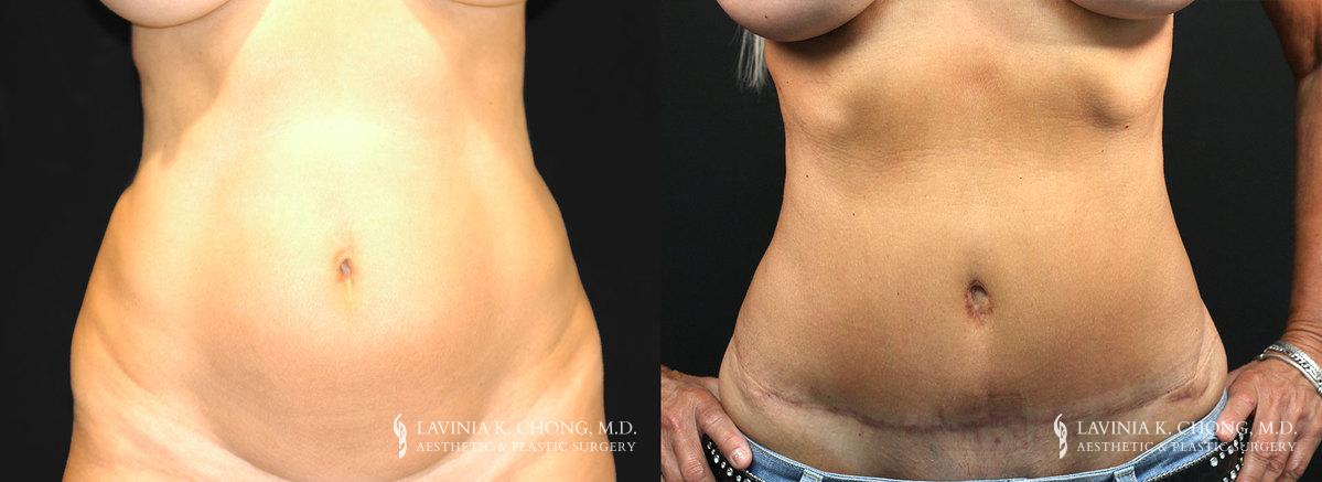 Tummy Tuck Before & After Photo Patient 2 - Front View