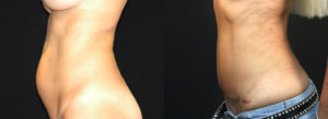 Tummy Tuck Before & After Photo Patient 2 - Side View