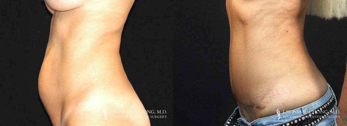 Tummy Tuck Before & After Photo Patient 2 - Side View