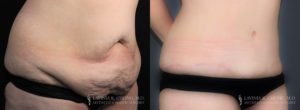 Tummy Tuck Before & After Photo Patient 3 - Angled View