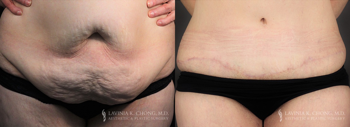 Tummy Tuck Before & After Photo Patient 3 - Front View