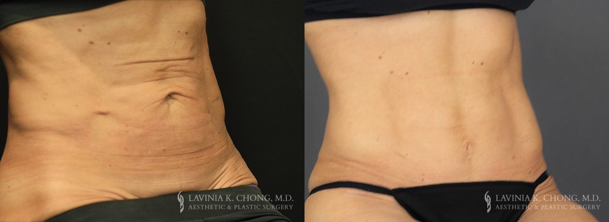 Tummy Tuck Before & After Photo Patient 4 - Angled View