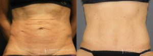 Tummy Tuck Before & After Photo Patient 4 - Front View