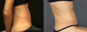 Tummy Tuck Before & After Photo Patient 4 - Side View