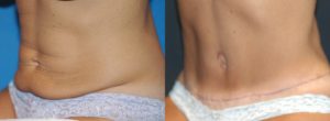 Tummy Tuck Before & After Photo Patient 5 - Angled View