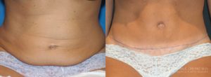 Tummy Tuck Before & After Photo Patient 5 - Front View
