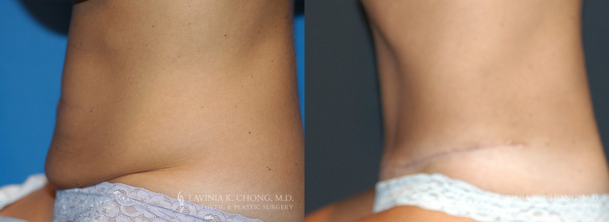 Tummy Tuck Before & After Photo Patient 5 - Profile View