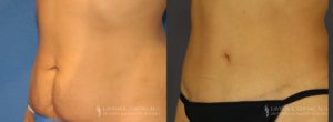 Tummy Tuck Before & After Photo Patient 6 - Angled View