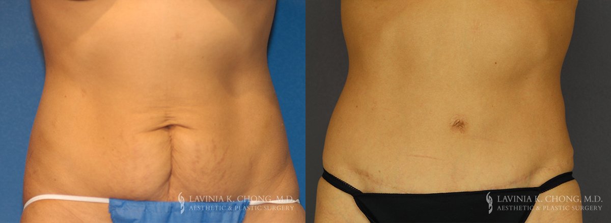 Tummy Tuck Before & After Photo Patient 6 - Front View