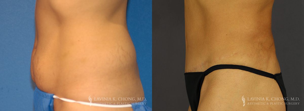 Tummy Tuck Before & After Photo Patient 6 - Side View