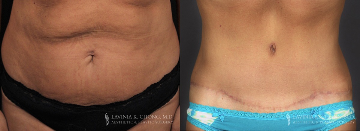 Tummy Tuck Before & After Photo Patient 7 - Front View