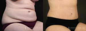 Tummy Tuck Before & After Photo Patient 8 - Angled View