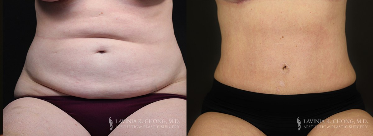 Tummy Tuck Before & After Photo Patient 8 - Front View