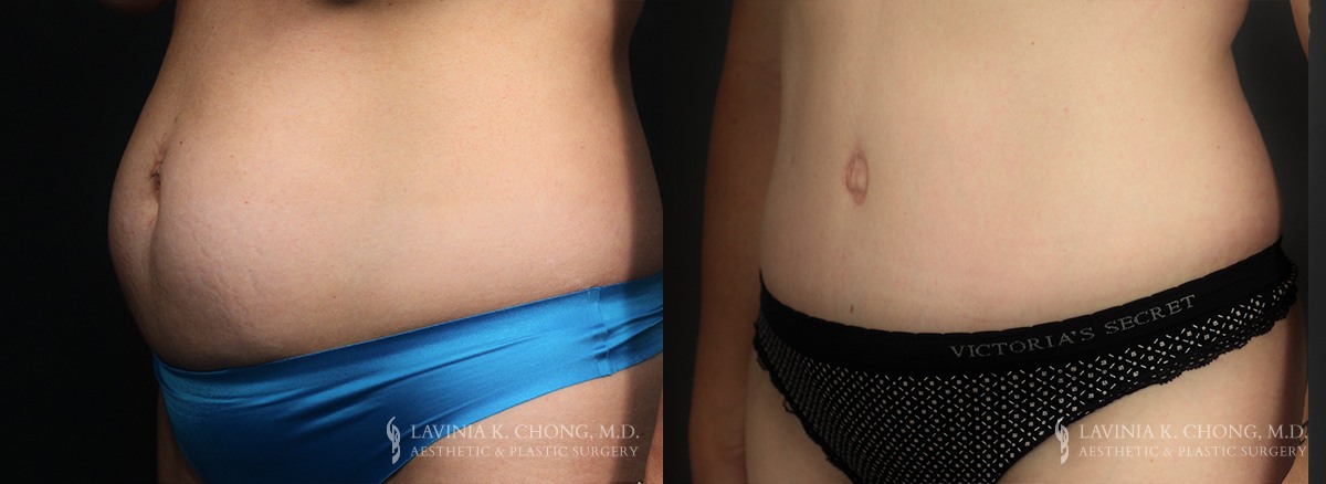Tummy Tuck Before & After Photo Patient 9 - Angled View