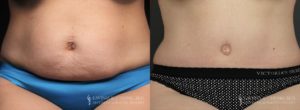 Tummy Tuck Before & After Photo Patient 9 - Front View